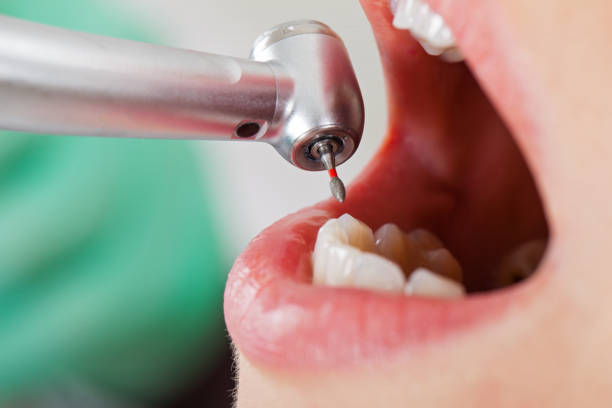Best Emergency Treatment for Dental Infections or Abscesses in Cumberland, IN
